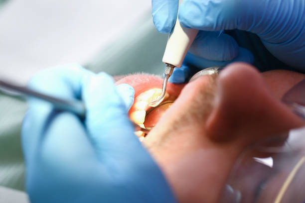Best Dental Abscess Treatment in Jefferson, GA